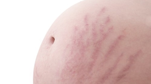 Stretch Marks — Treatments, Causes and Prevention