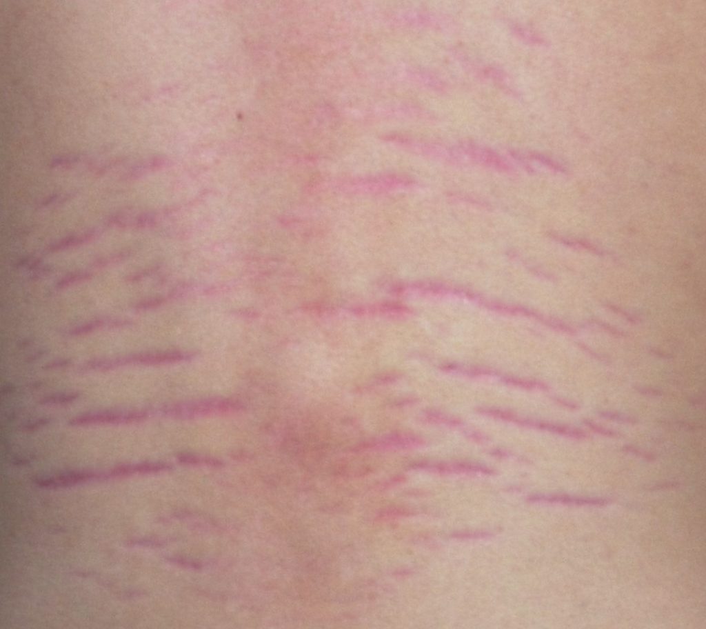 Stretch Marks Explained: Causes, Prevention, and Treatments - StretchMarks .org