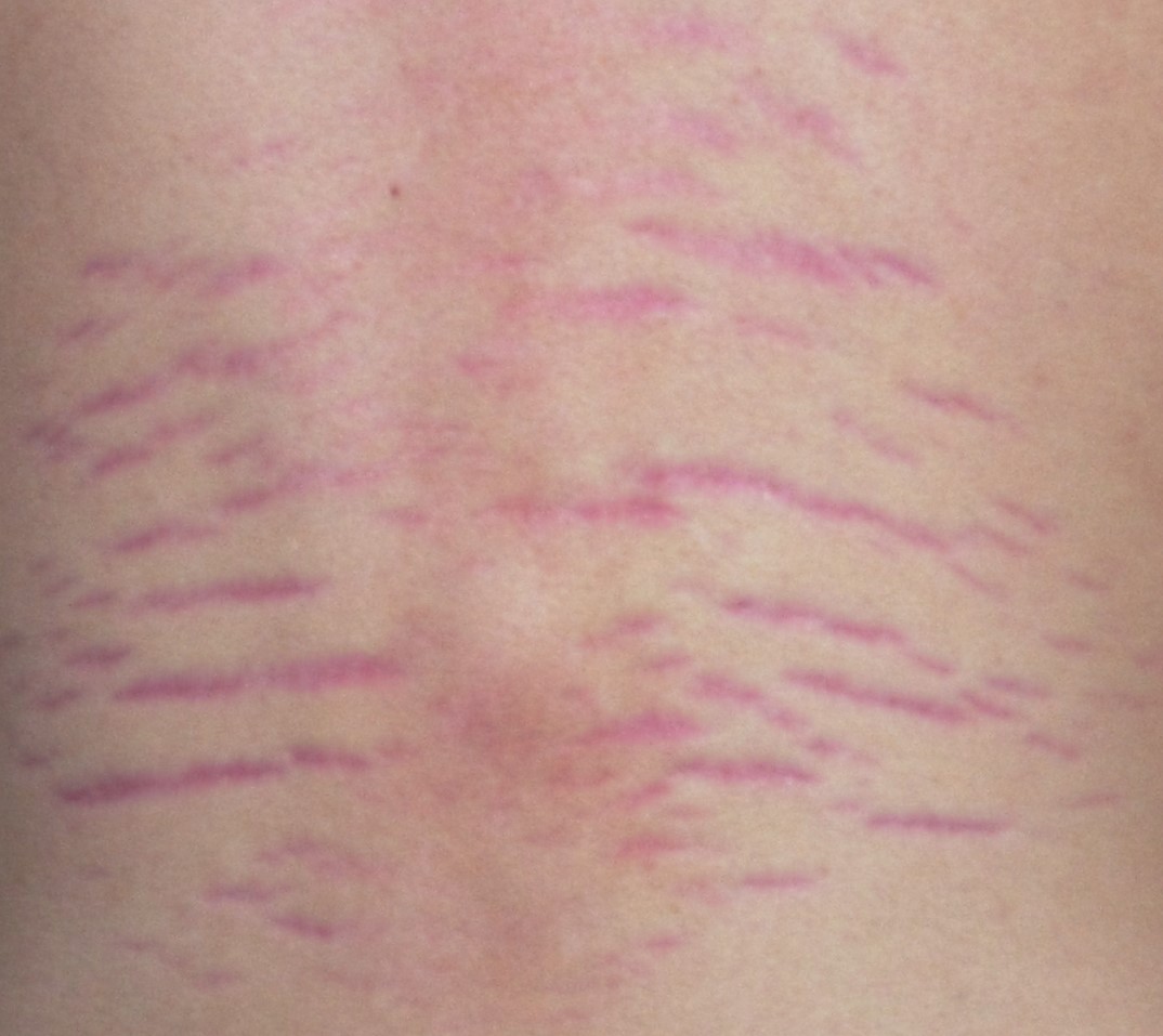 Stretch Marks Explained Causes, Prevention, and Treatments